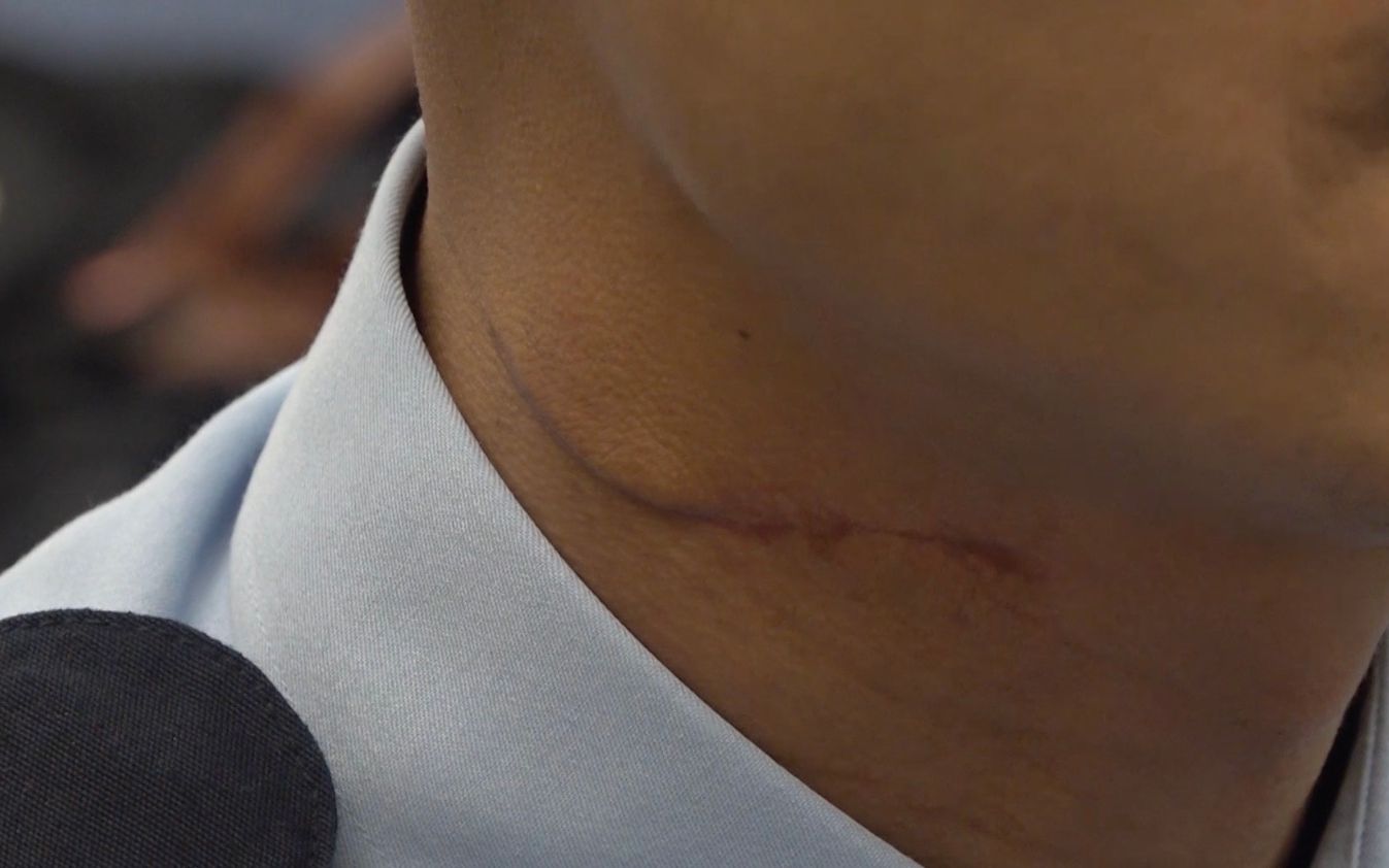 Alex颈部的伤痕仍未痊愈。新京报特派香港报道组