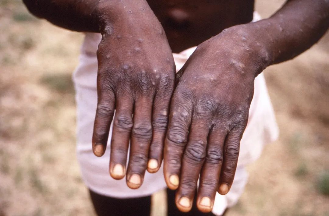 （资料图片）非洲一名猴痘患者展示其手部。图/CDC